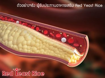 ตัวอย่างจริง ผู้รับประทานอาหารเสริม Red Yeast Rice